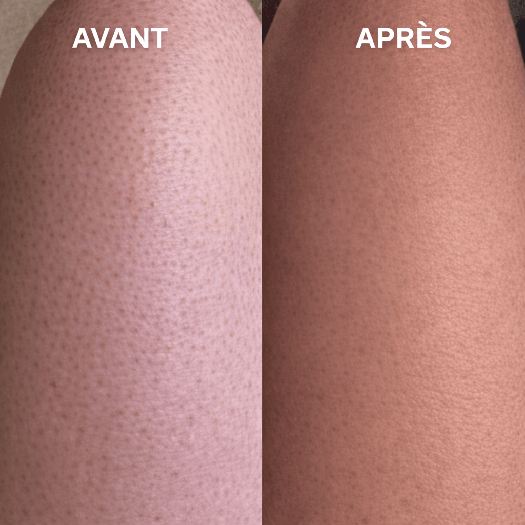 Gant exfoliant kératose pilaire - Freshpalm™